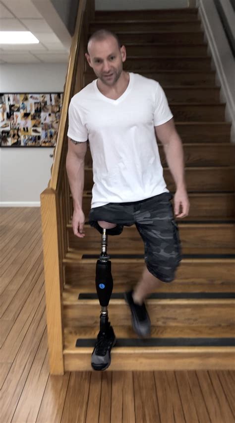 Osseointegration Stairs Ak A Step Ahead Prosthetics