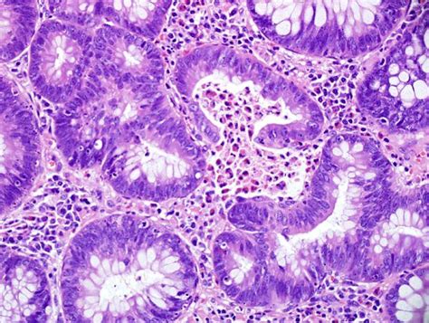 Qiao S Pathology Colon Tubular Adenoma With High Grade Flickr