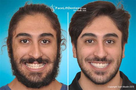 Maybe you would like to learn more about one of these? Jaw Surgery Alternative - Under Bite Correction