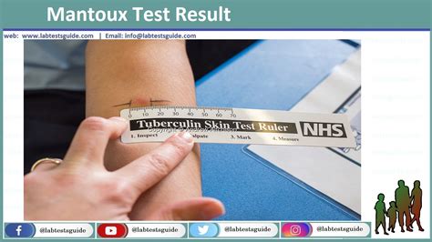 Tuberculosis Skin Test Ppd Porpuse Procedure Results Lab Tests Guide