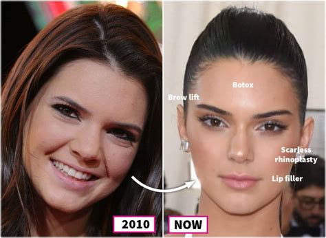 Kylie Jenner Plastic Surgery Before And After - celebrity ...