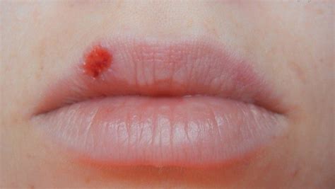 If you have the cold sores, you need to toss your toothbrush and repeat this action again after the sore has cleared up. How to prevent cold sores from spreading naturally - 9 tips