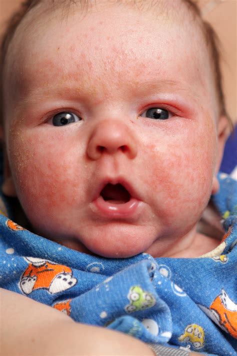 Granitos En La Cara De Mi Bebé De Un Año Salud180