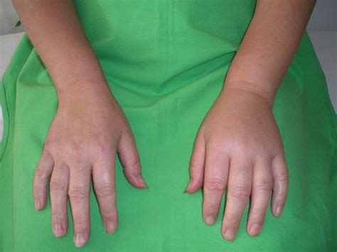 Subcutaneous Edema On The Left Hand Of A Patient With Hae C1 Inh