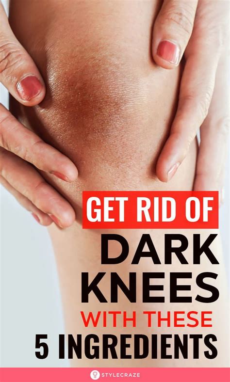Get Rid Of Dark Knees With These 5 Ingredients In 2020 Brown Spots On Face Spots On Face Skin