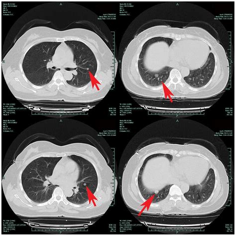 Pulmonary Hamartoma Resembling Multiple Metastases A Case Report