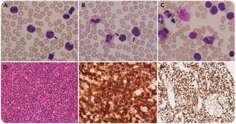Alk Small Cell Variant Of Anaplastic Large Cell Lymphoma With Leukemic