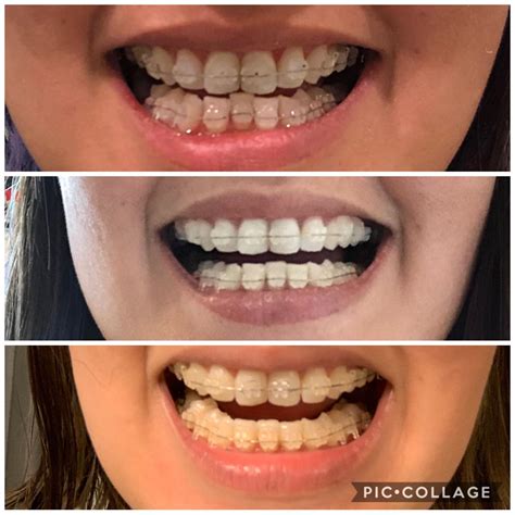 Progress Braces And A Bite Plate Top Day 1 Mid 6 Weeks A Little Over