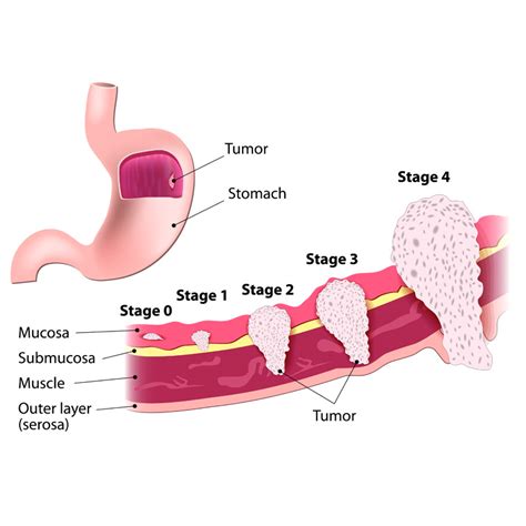 Partial Gastrectomy Stomach Cancer Treatments Huntsville Al