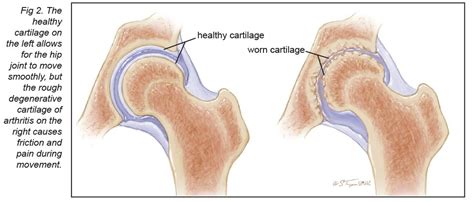 Arthritis Of The Hip Joint Mu Health Care