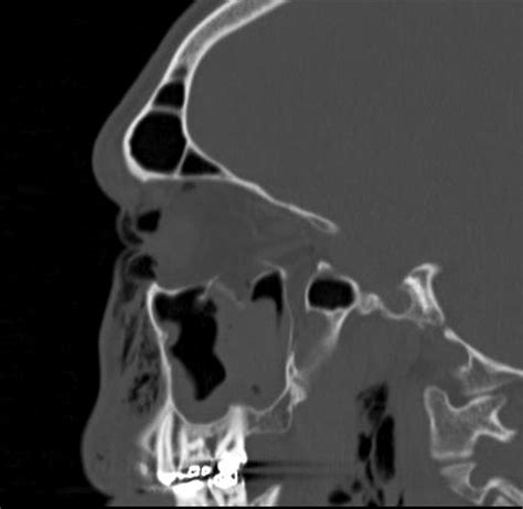 Comminuted Orbital Blowout Fracture After Vigorous Nose Blowing That