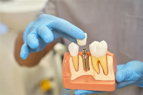 Dental Implant Vs Crown Pros And Cons Explored