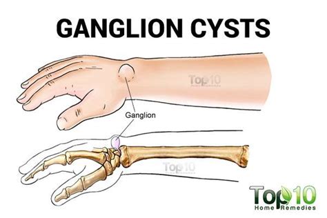 The dorsal radial zone is the area of the wrist near the thumb over the palm side. Home Remedies for Ganglion Cysts | Top 10 Home Remedies