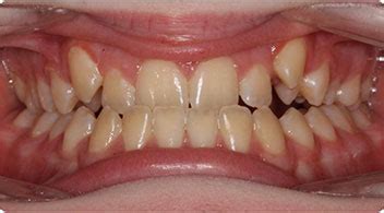 Can you fix an overbite without braces. Can Underbite Be Fixed Without Braces?