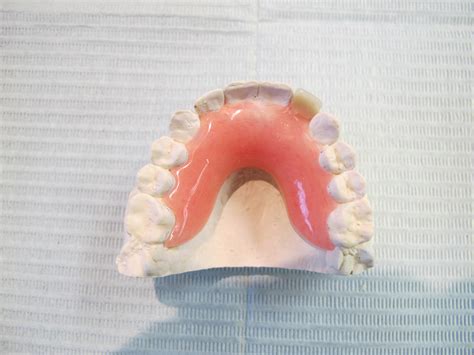Acrylic Partials The Denture Source