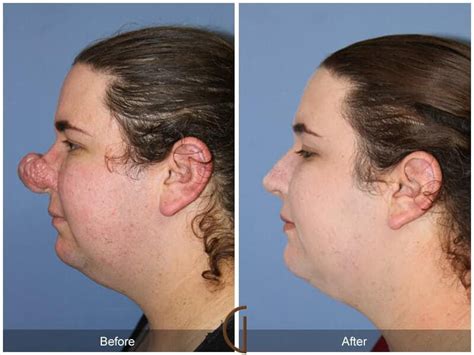 Tip Rhinoplasty Before And After Photos From Dr Kevin Sadati