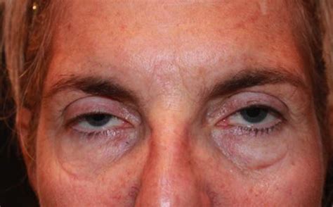 Ptosis Drooping Upper Eyelid The Zatezalo Group