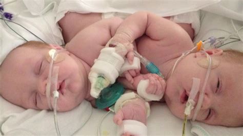 Once Conjoined Twins Head Home