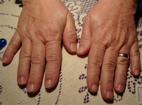 Hand Manifestations Of Diabetes Mellitus Page 2