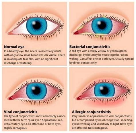 What S The Difference Between Allergies And Pink Eye Lestgodo