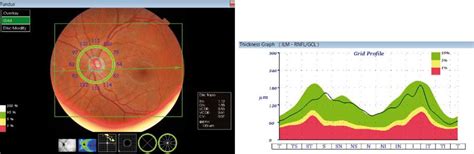 Nowe możliwości obrazowania dna oka w optycznej koherentnej tomografii