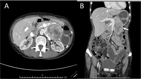 Axial A And Coronal B View Of Contrasted Abdominal Ct Showed