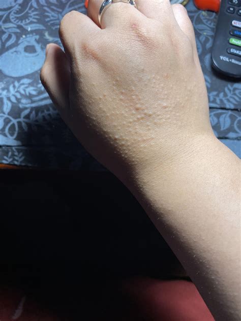 Small Itchy Bumps On Back Of Hands