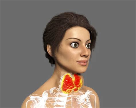 Hyperthyroidism Illustration Showing Enlarged Thyroid Gland