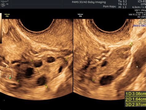 Gynaecological Pelvic Scan Private One On One Pregnancy And Fertility