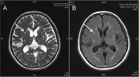 A Axial Cranial T2 Weighted Mri Shows A Lacunar Infarct Lesion Of