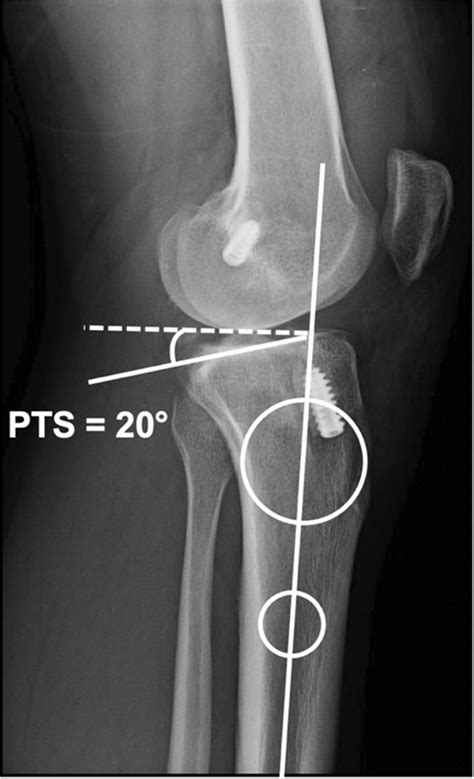 Lateral Radiograph Of The Knee With “circle Three Point Method” 7• To
