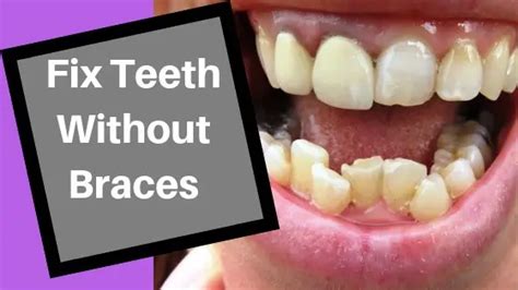 How To Fix Crooked Teeth Without Braces At Home Straighten Teeth