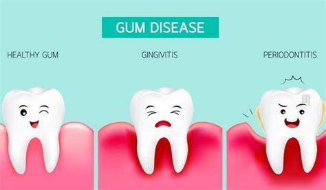 Everything You Need To Know About Periodonal Gum Disease