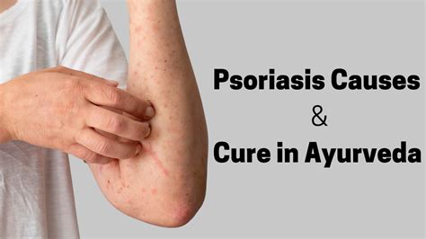 Psoriasis Causes And Cure In Ayurveda