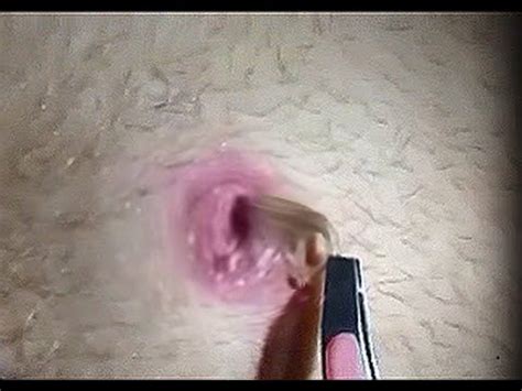 (if it is revealed that antibiotics are less effective). Mega hair Ingrown hair removal | Ingrown hair removal ...