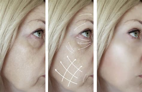 Woman Face Wrinkles Removal Cosmetology Dermatology Patient Medicine