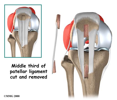 Physical Therapy In Indialantic For Anterior Cruciate Ligament Injury