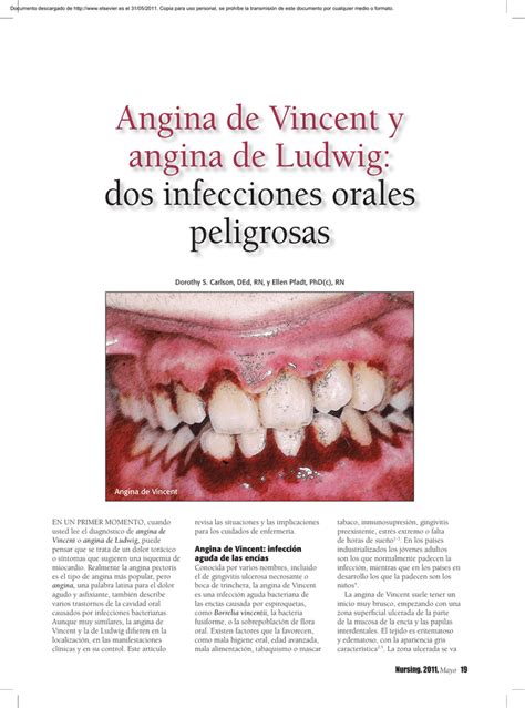 Angina De Vincent Y Angina De Ludwig Dos Infecciones Orales