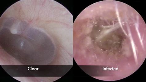 Ear Infection | Causes, Symptoms and Treatment