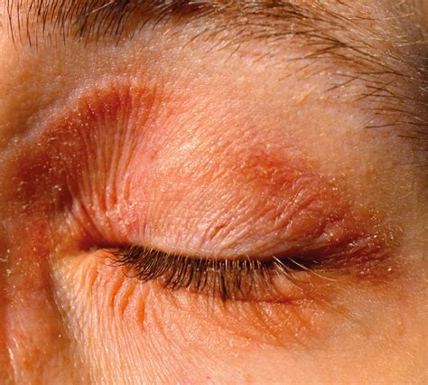 Eczema Around Eyes Top Home Treatment Tips 2023 Yanyeeskincare