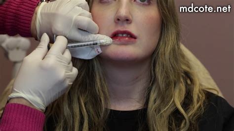 Lip Filler On Thin Lips Start To Finish With 1 Syringe Of Juvederm