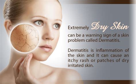 Dry Skin Can Be More Than Just Itchy See Us For Help Extremely Dry