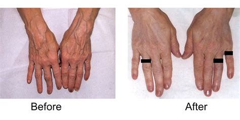 Hand Veins Treatment And Removal Madison Vein And Laser