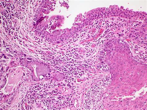 In Situ And Invasive Squamous Cell Carcinoma Case 224 Flickr Photo