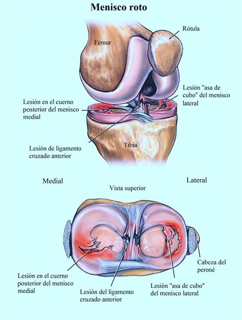 dolor de rodilla interno lateral causas síntomas y tratamiento