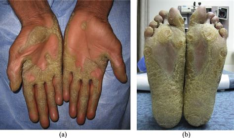 Hyperlipidemia Secondary To Acitretin Therapy For Lamellar Ichthyosis