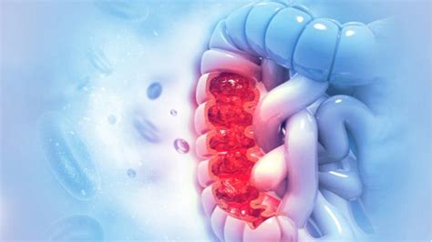 Vitamin D Bisa Bantu Melawan Kanker Usus Besar Klikdokter