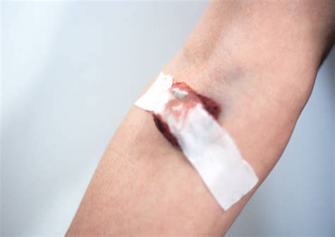 Iv Bruise Stock Photos Pictures And Royalty Free Images Istock