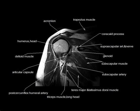 Attached to the bones of the skeletal system are about 700 named. MRI shoulder anatomy | shoulder coronal anatomy | free ...