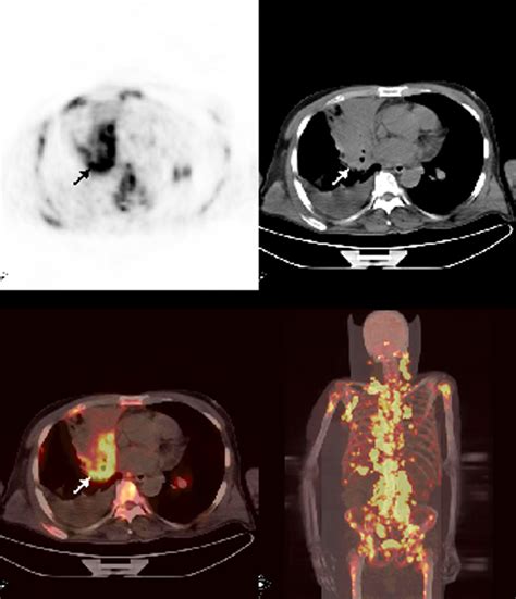 Axial And Mip Petct Images Showed A Mass At The Right Hilar Region